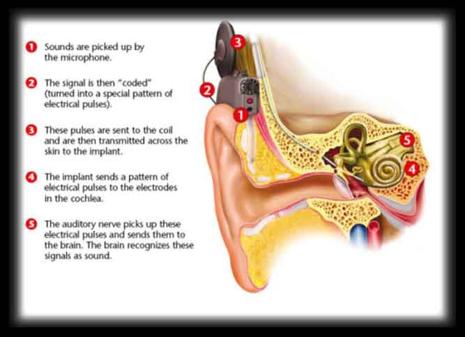 cochlearimplant1-optimized Desktop Audio Booth